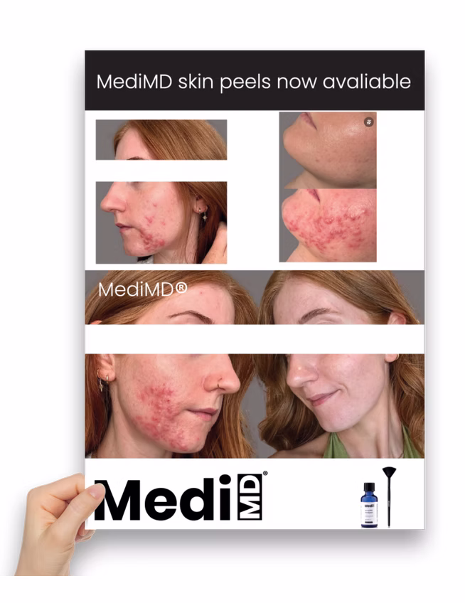 Superficial AHA Peel