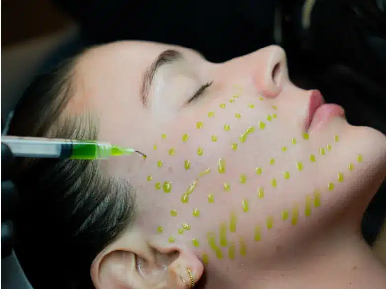Bio-Needle Dermal Infusion